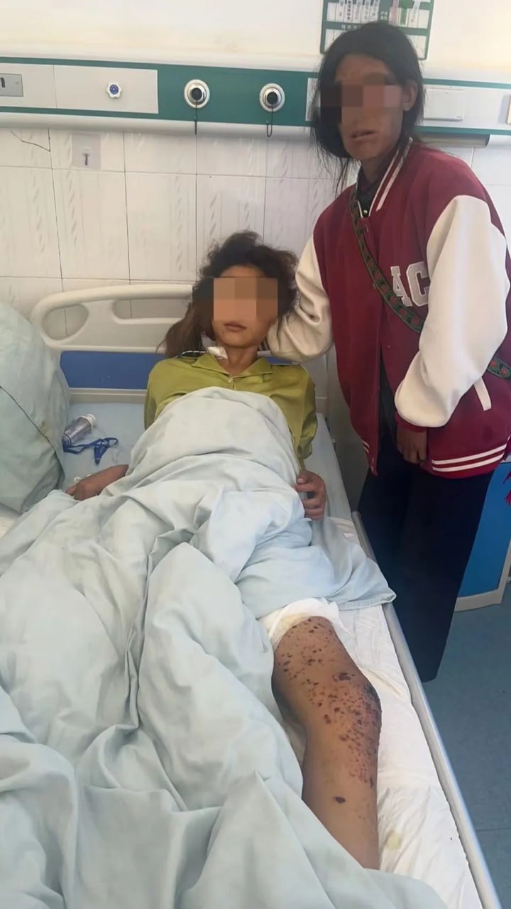 果敢昔娥、木邦城区同日遭缅军战机轰炸平民至少3死10伤 一女孩误触地雷小腿被炸断 